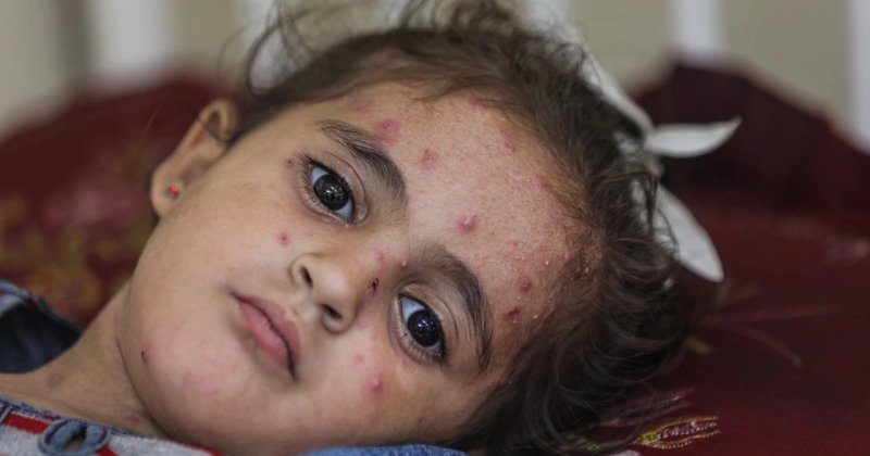 Gazze'deki çocuklarda cilt hastalıkları yayılıyor